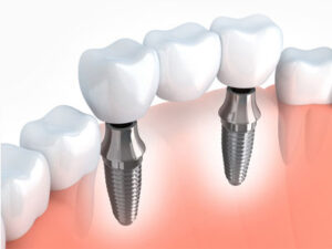 Best Dental Implants Specialist nearby, Teeth Implants specialist in Ahmedabad