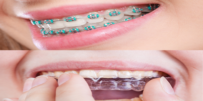 Braces vs Aligners