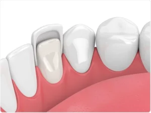 dental veneers