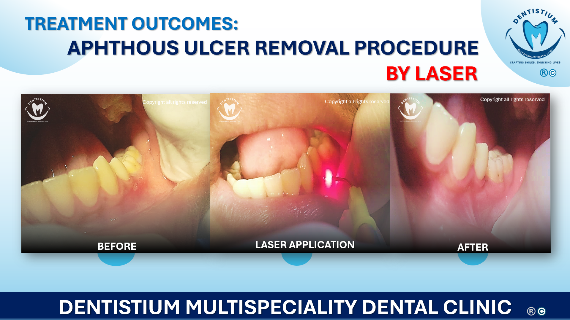Aphthous Ulcer Removal Procedure By Laser