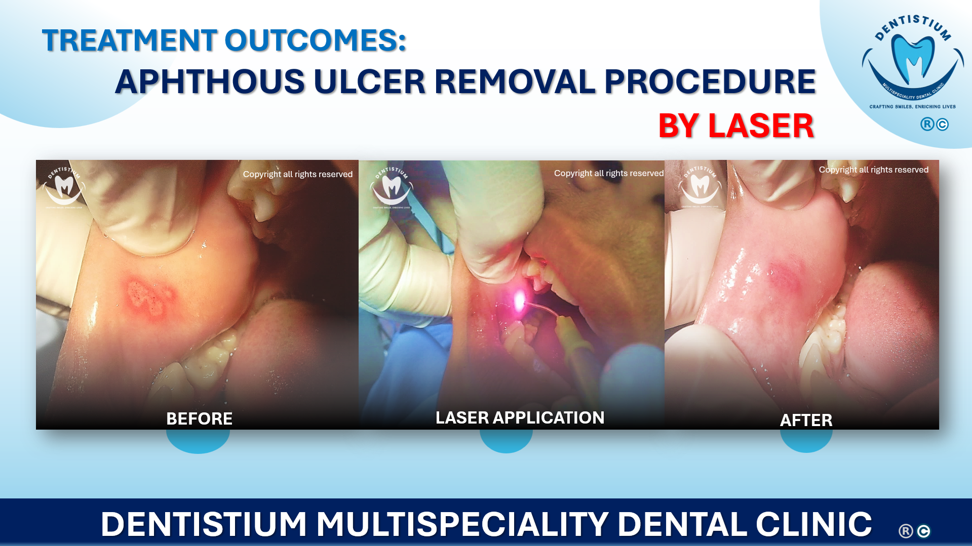 Aphthous Ulcer Removal Procedure By Laser