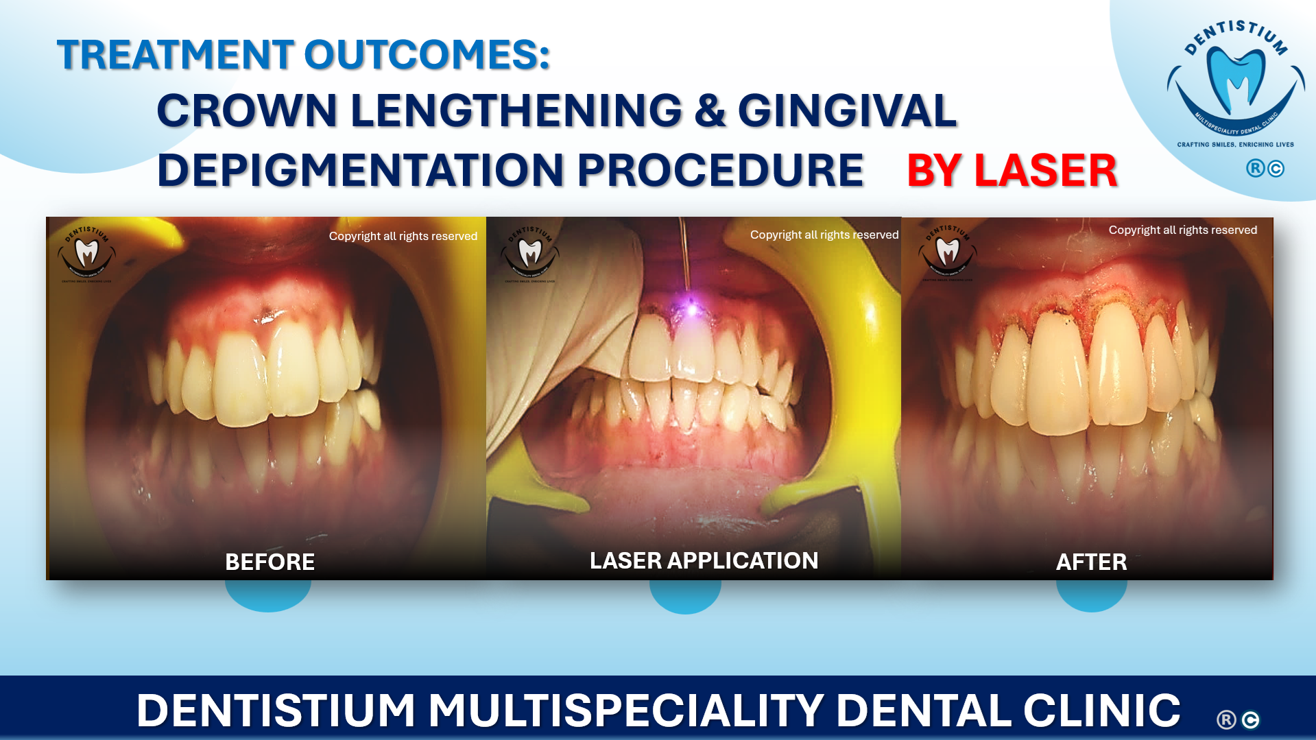 Crown Lengthening & Gingival Depigmentation Procedure By Laser