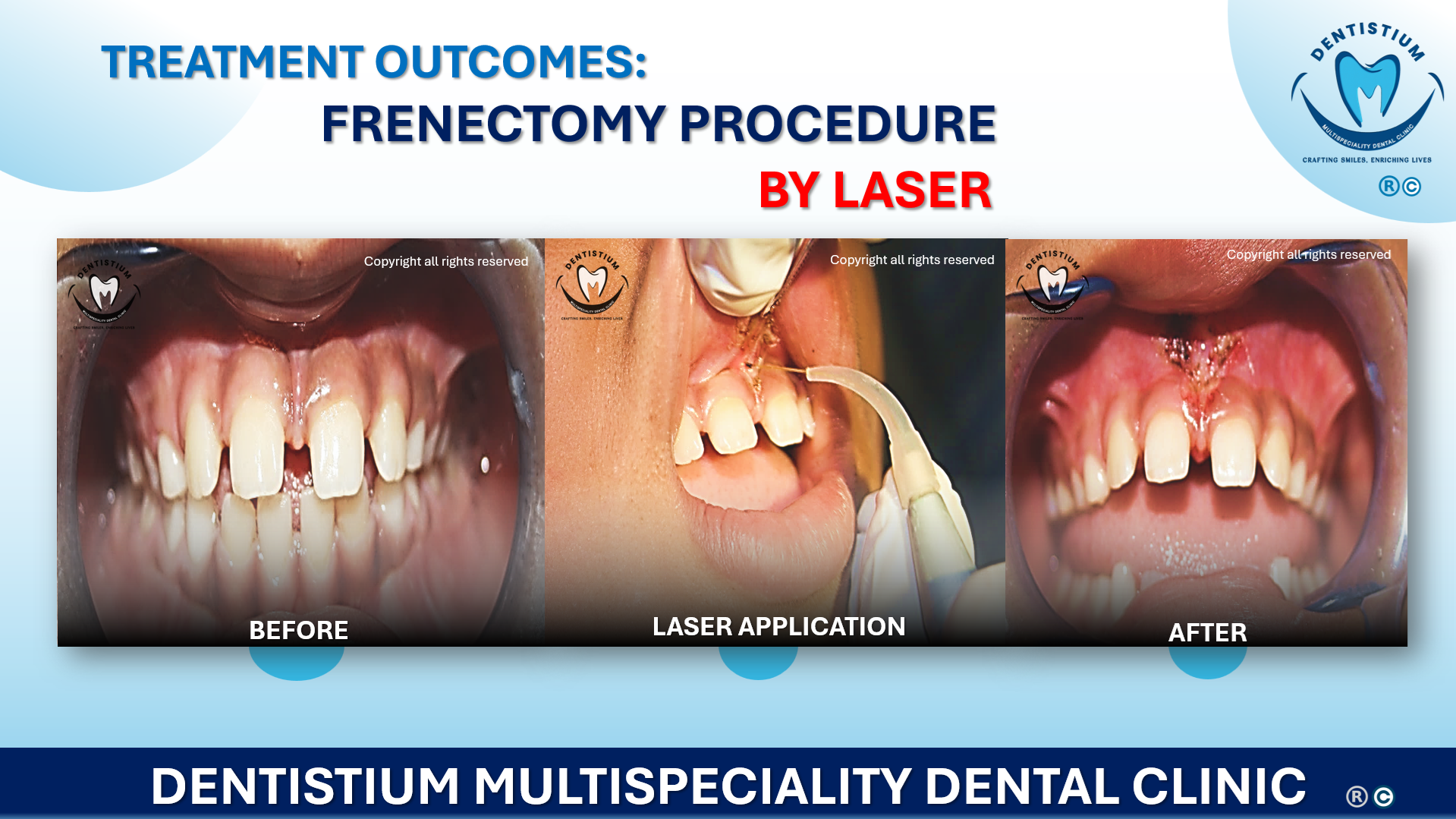 Frenectomy Procedure By Laser