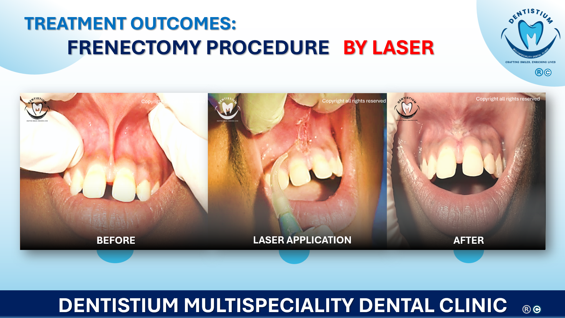 Frenectomy Procedure By Laser