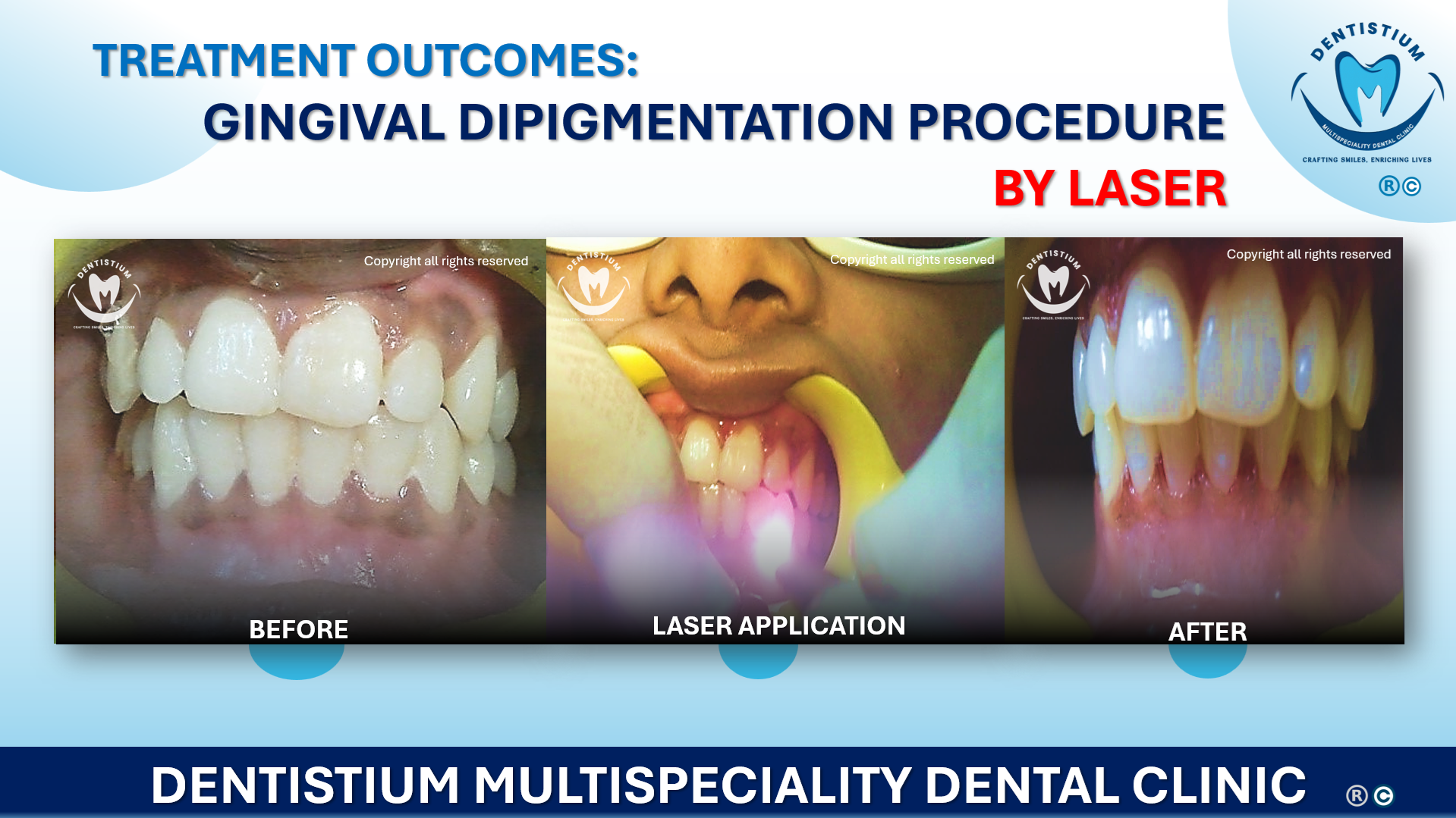 Gingival Depigmentation Procedure By Laser