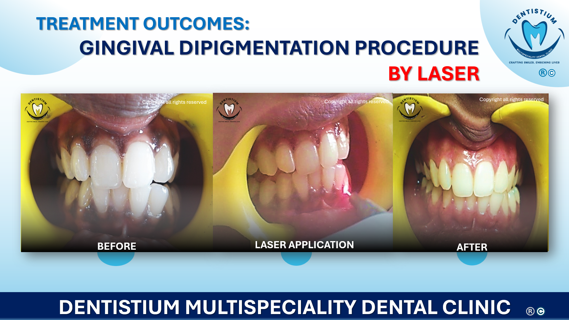 Gingival Dipigmentation Procedure By Laser