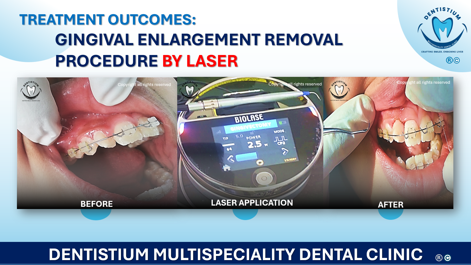 Gingival Enlargement Removal Procedure By Laser