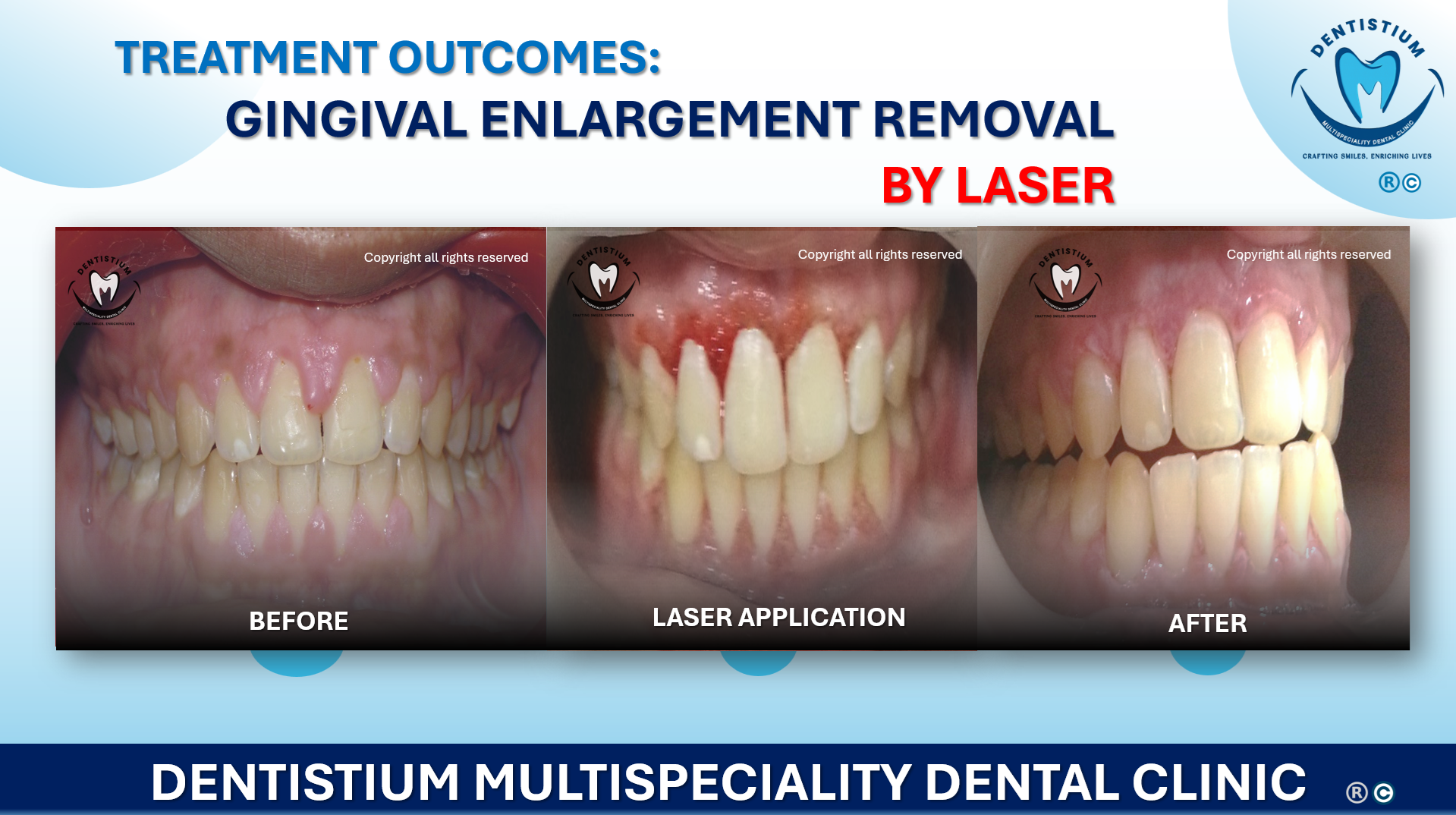 Gingival Enlargement Removal By Laser