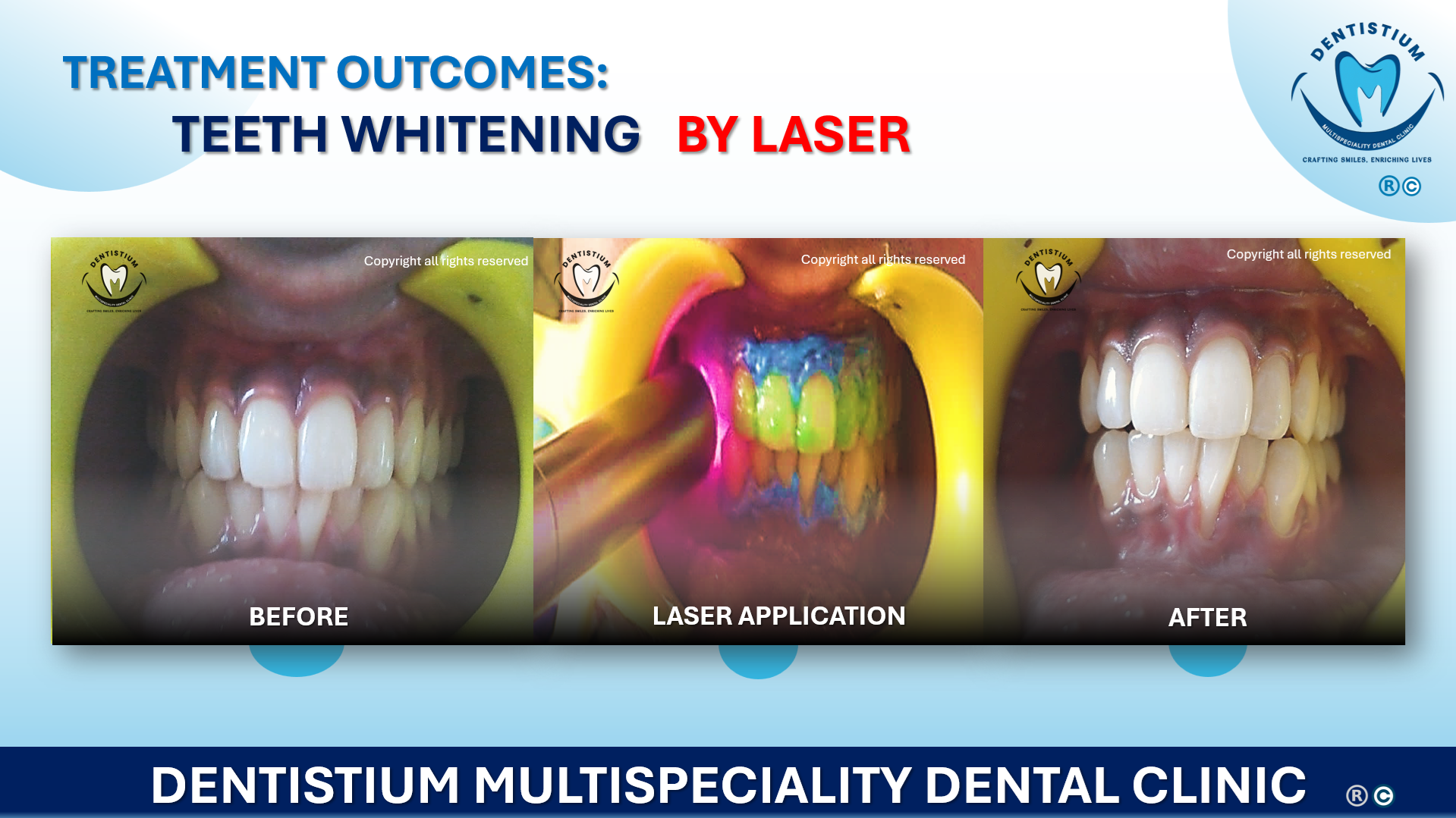 Teeth Whitening By Laser