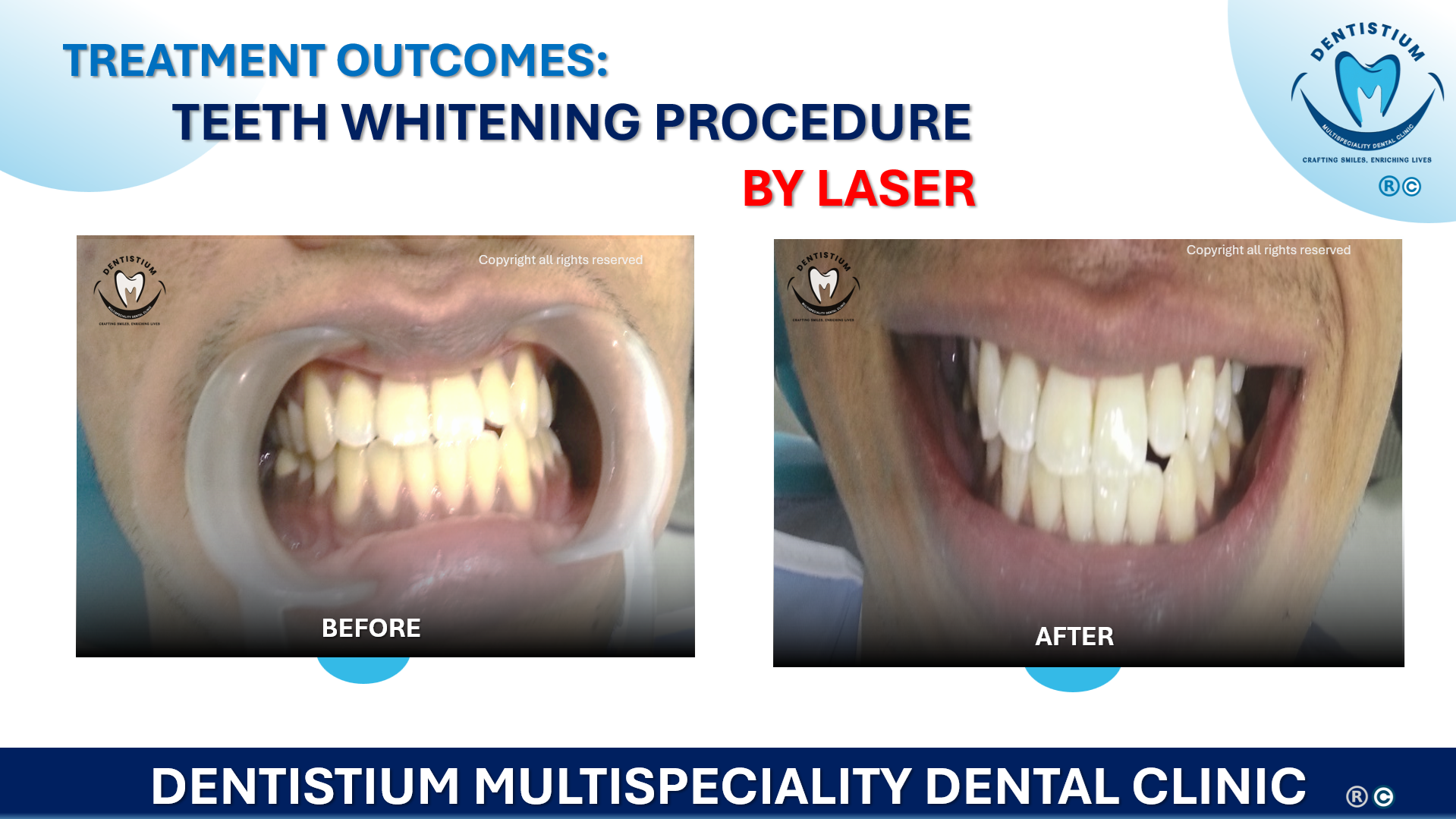 Teeth Whitening Procedure By Laser