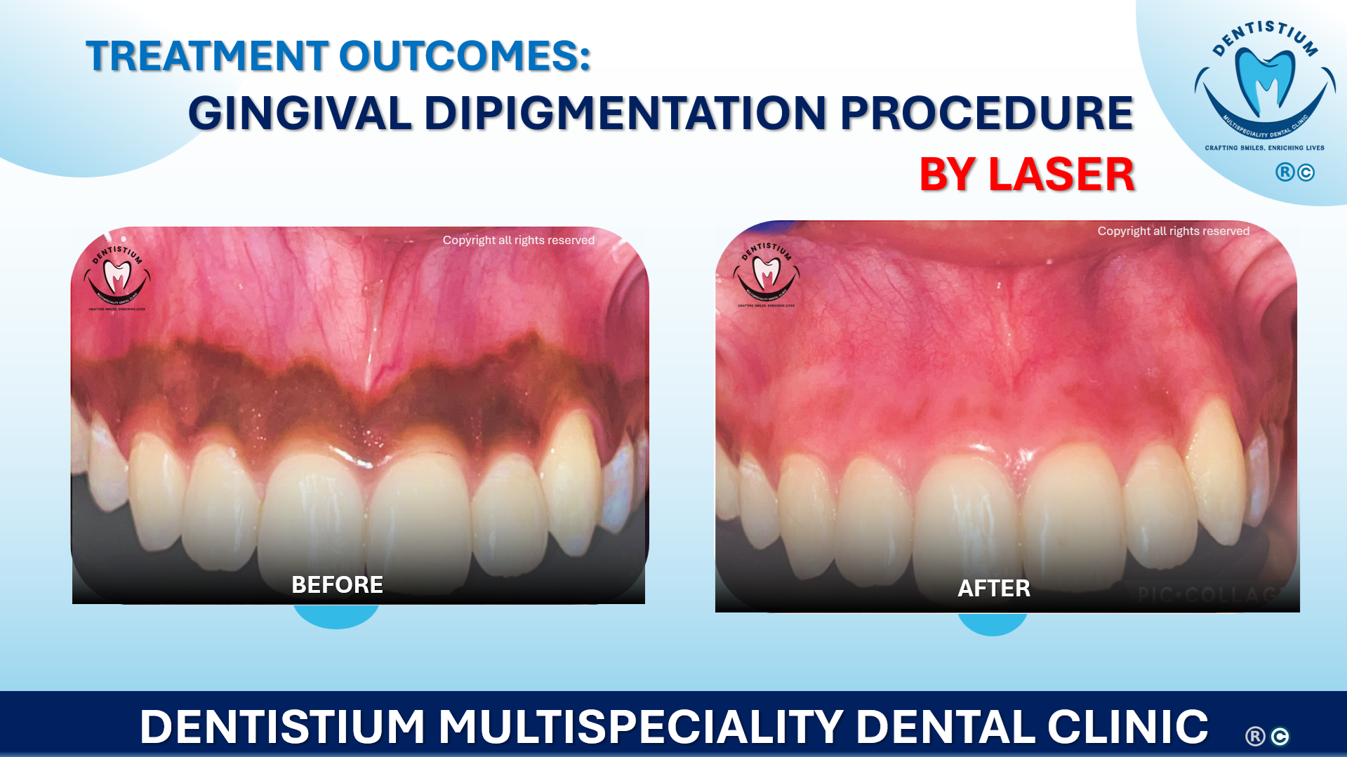 Gingival Dipigmentation Procedure By Laser