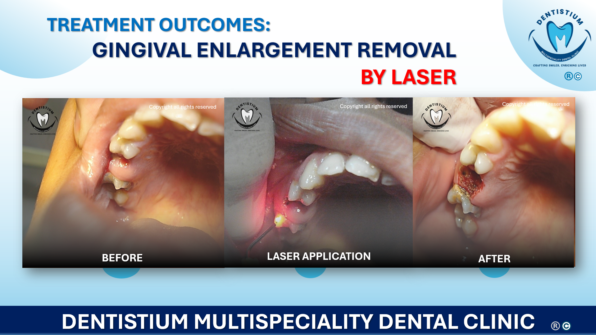 Gingival Enlargement Removal By Laser