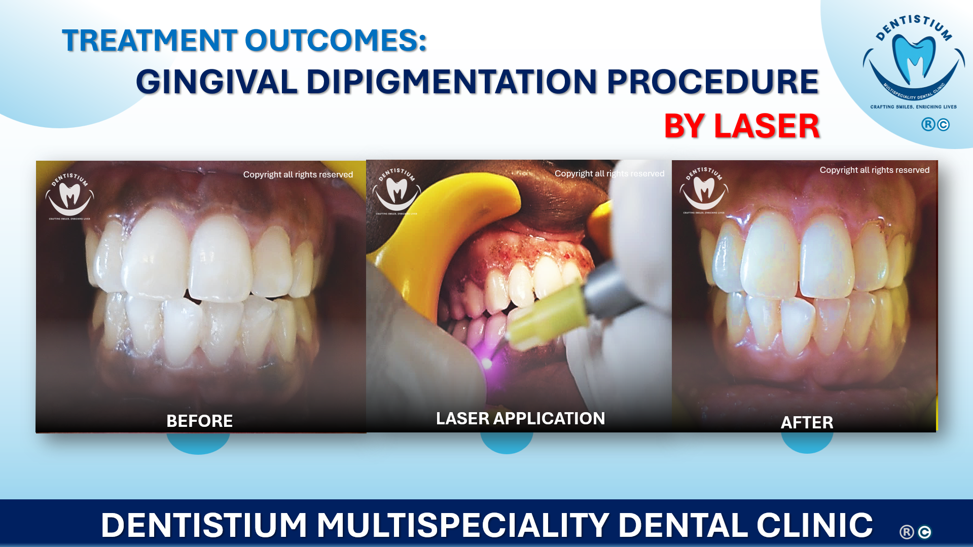 Gingival Depigmentation Procedure By Laser