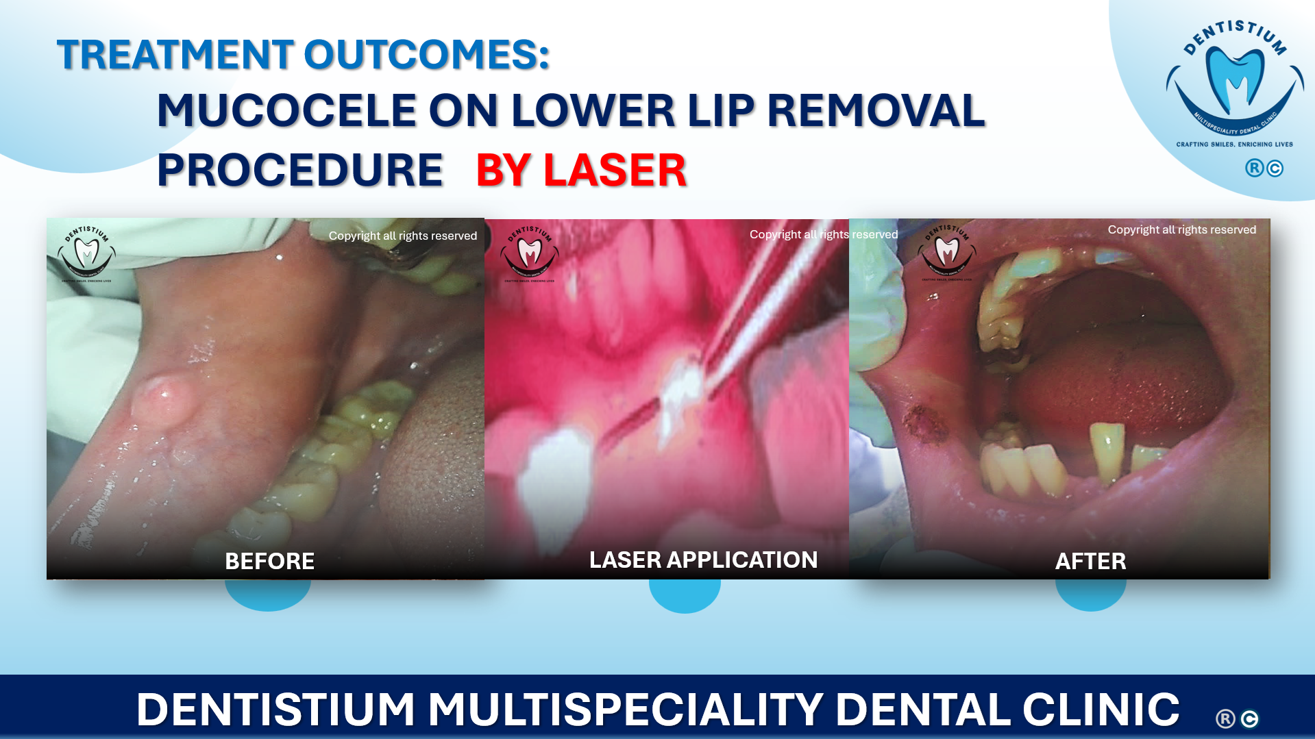 Mucocele on Lower LIP Removal Procedure By Laser