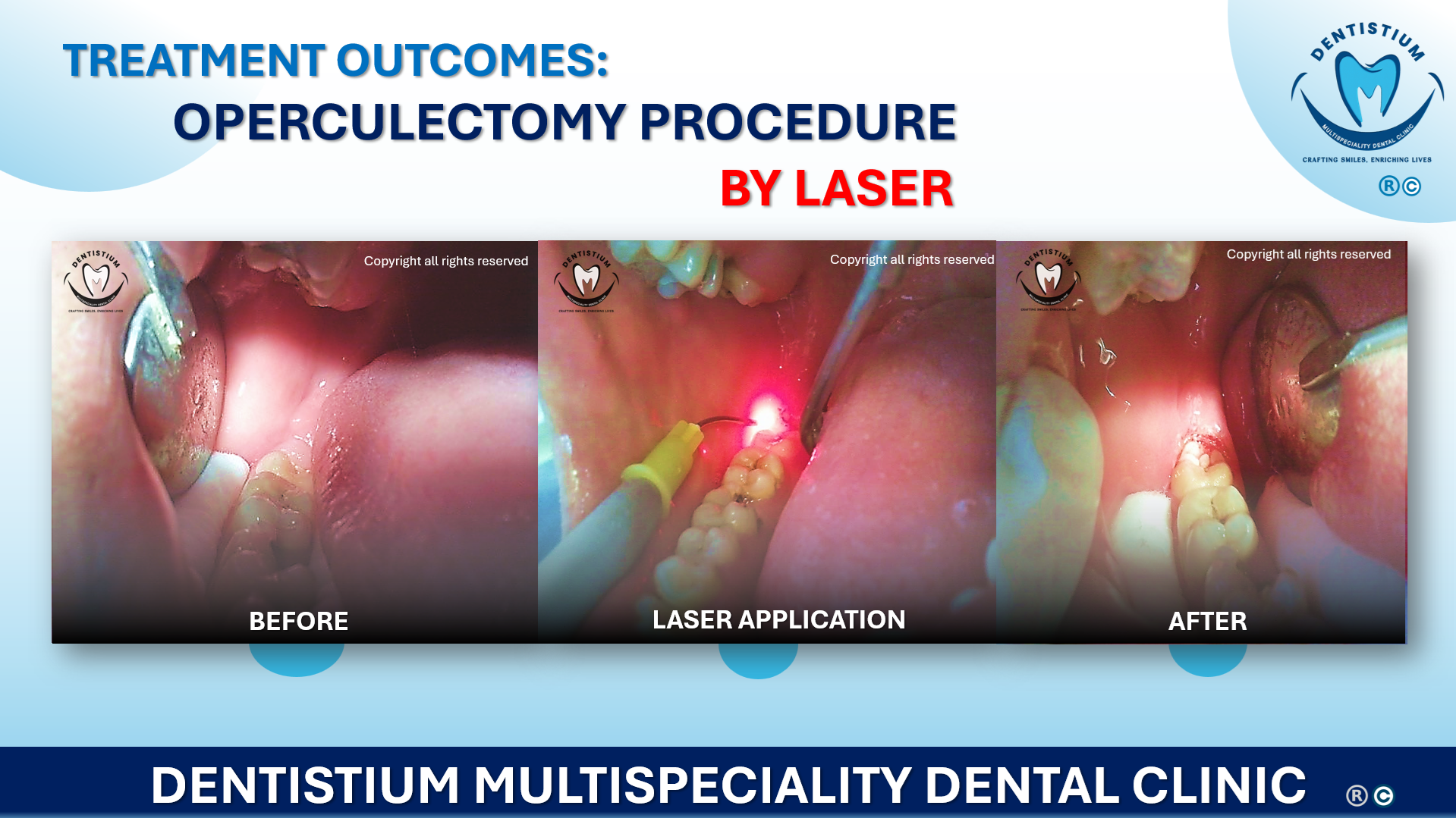 Operculectomy Procedure By Laser