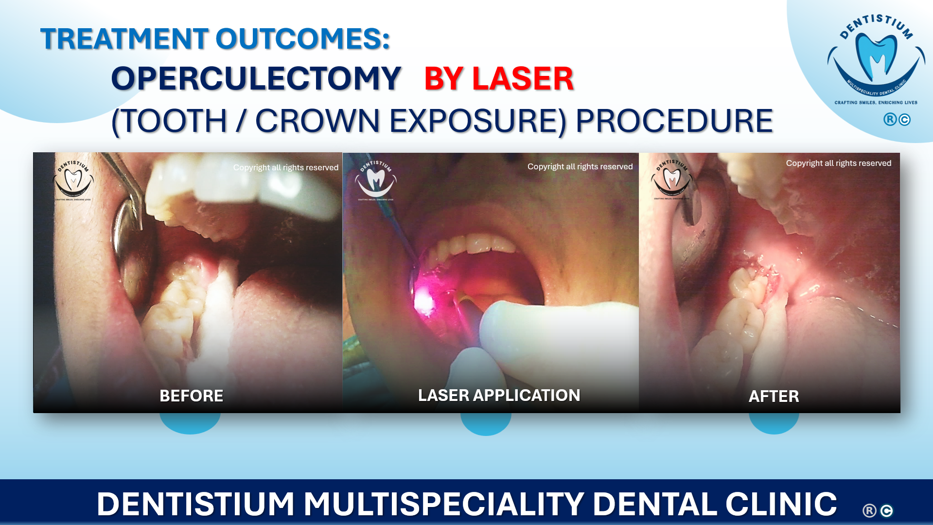 Operculectomy By Laser (Tooth / Crown Exposure) Procedure