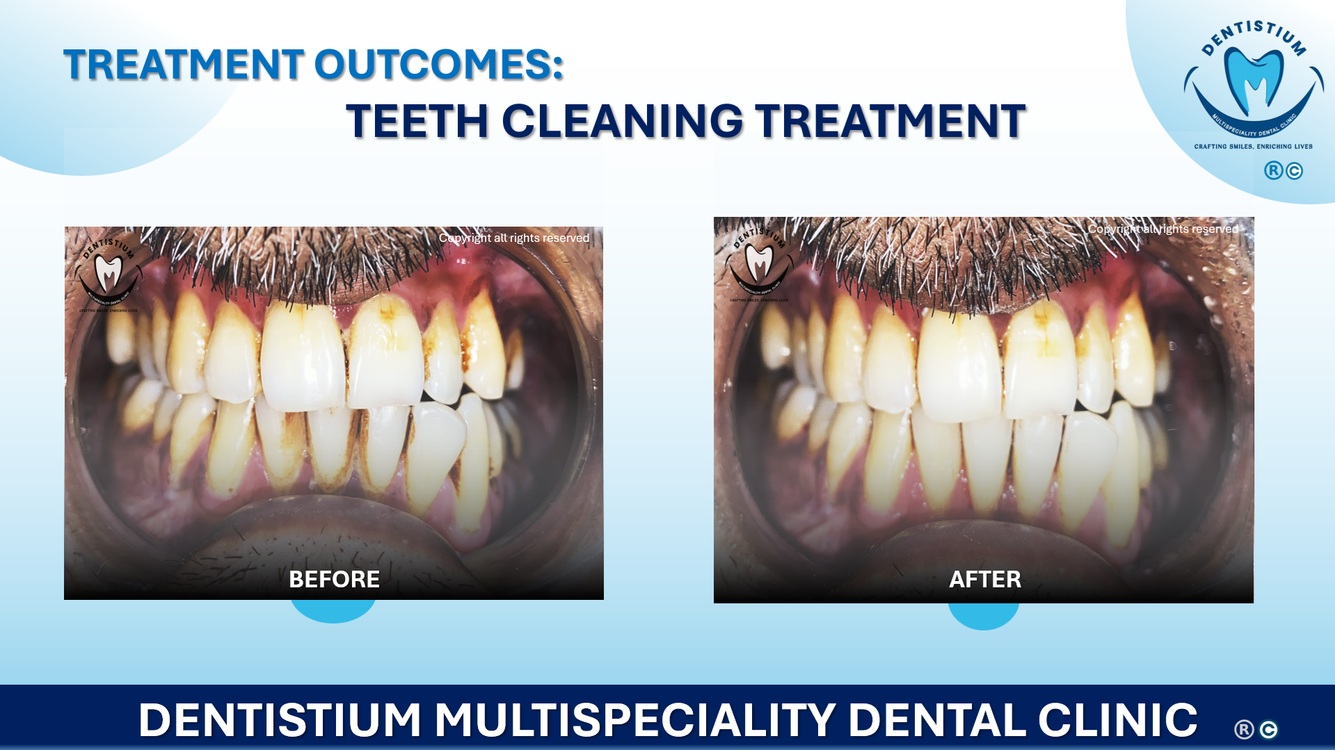 Teeth Cleaning Treatment