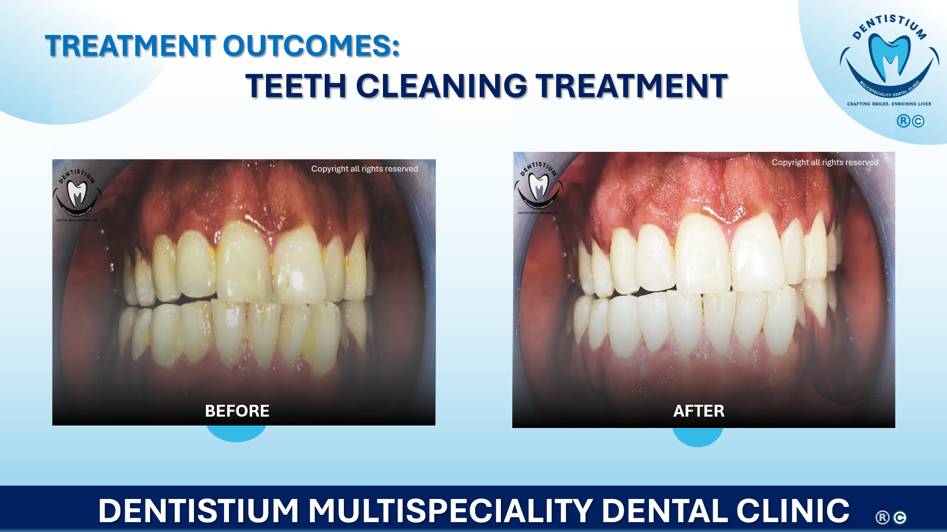 Teeth Cleaning Treatment