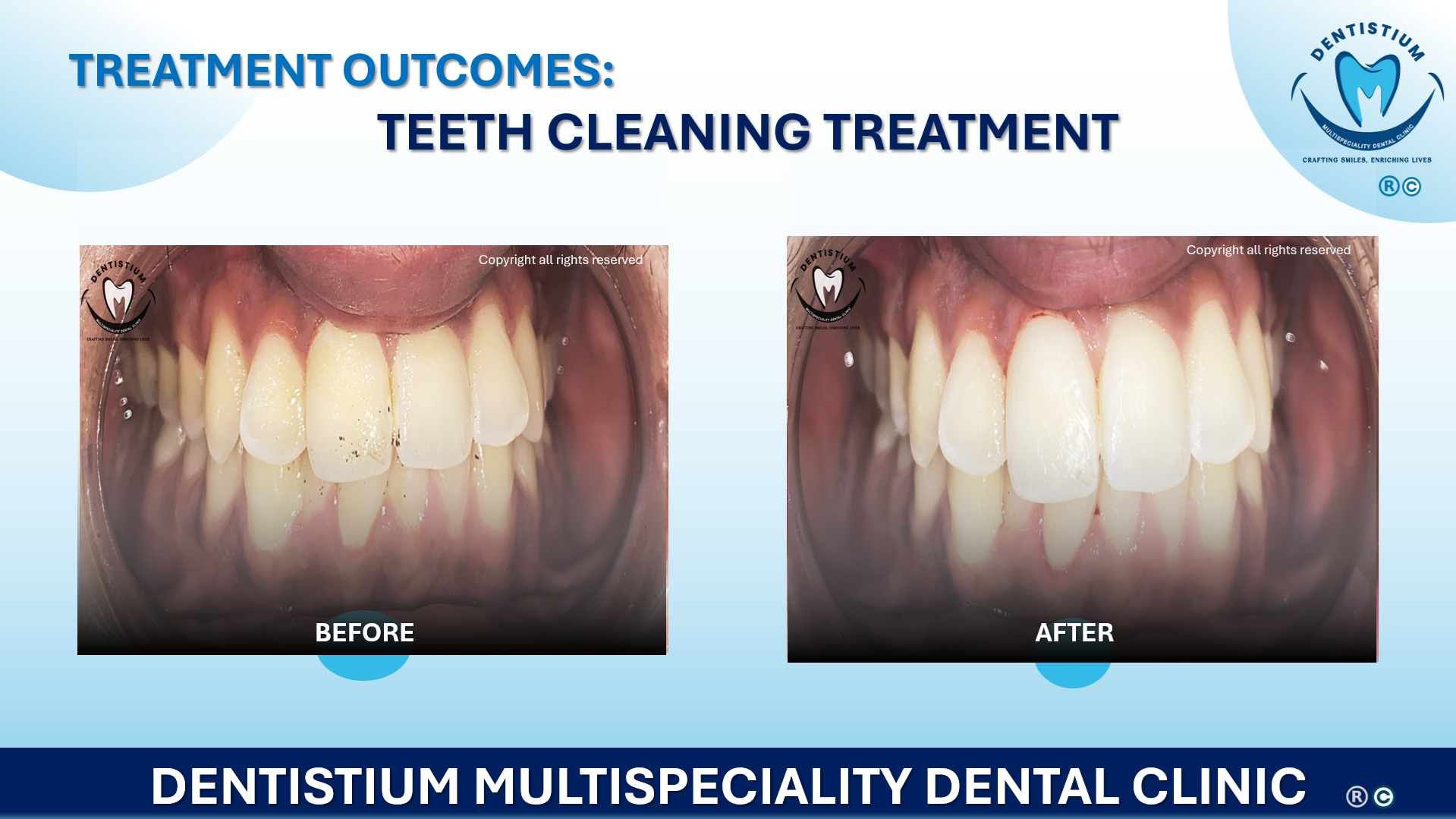 Teeth Cleaning Treatment