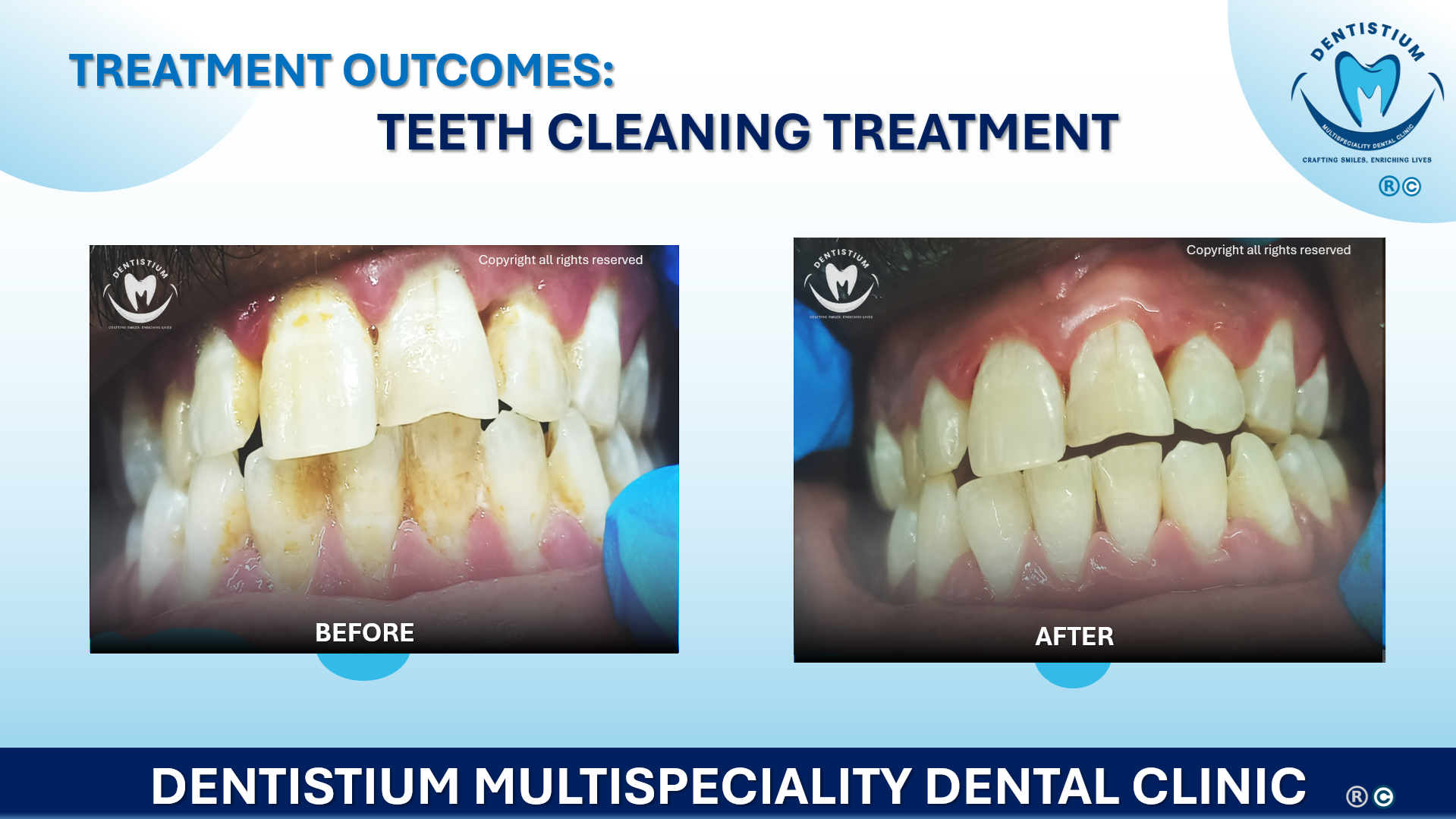 Teeth Cleaning Treatment