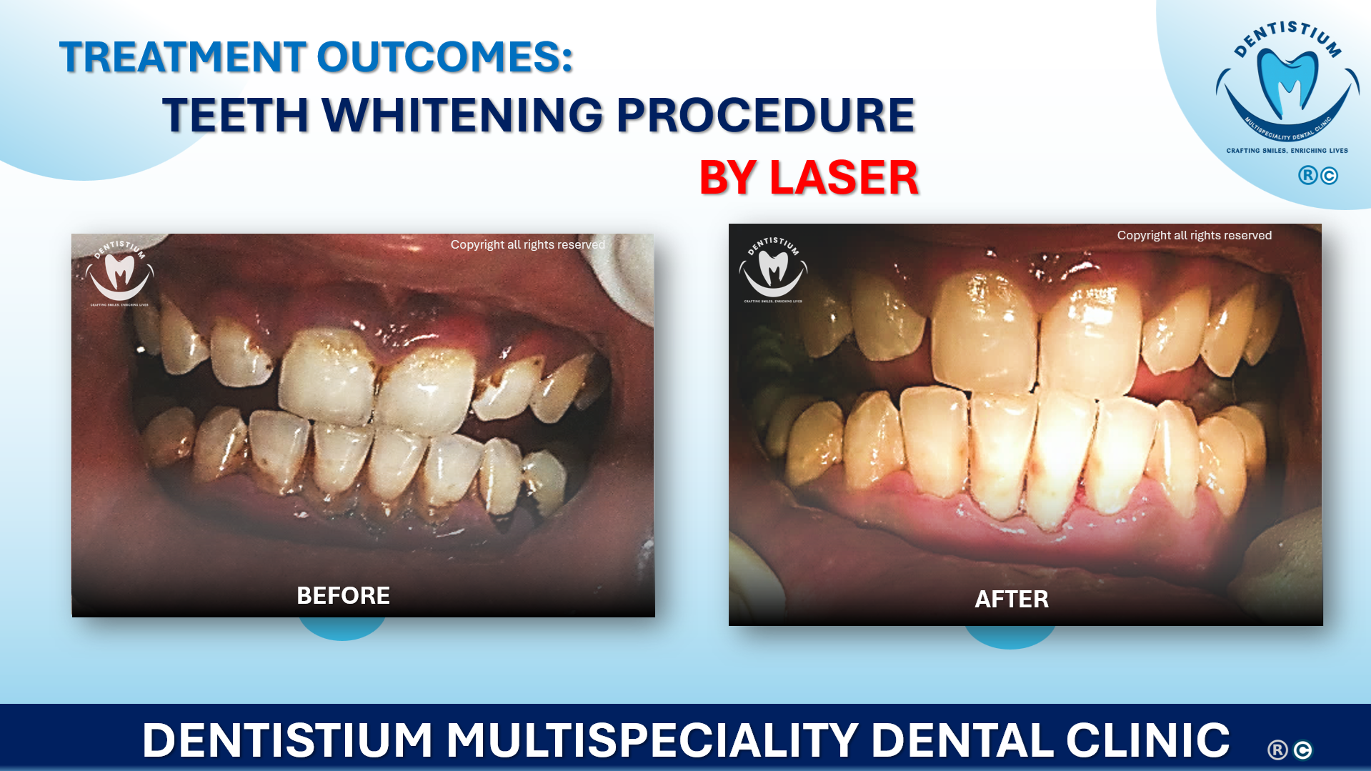 Teeth Whitening Procedure By Laser